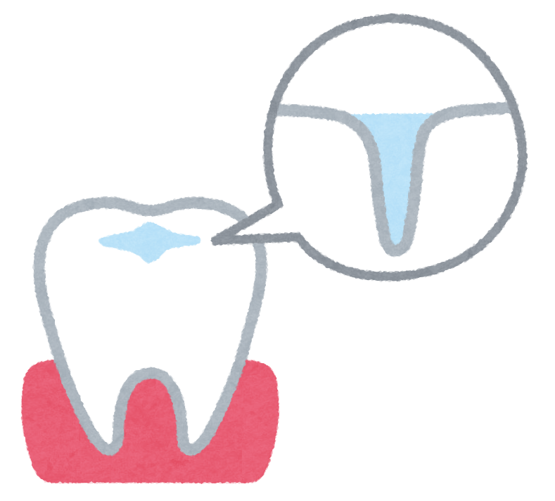 福岡市西区姪浜りんご歯科のシーラント